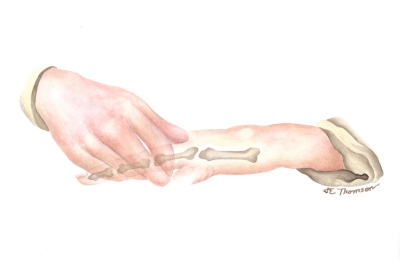 Hand Exercise 1, Dupuyten's Contracture
