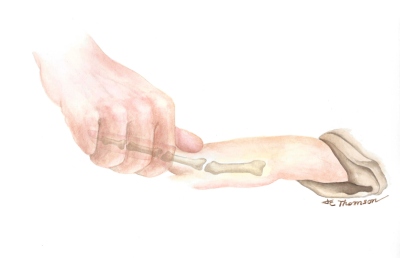 Hand Exercise 2, Dupuyten's Contracture