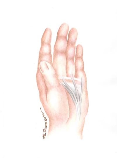 Dupuyten's Contracture, After Exercises
