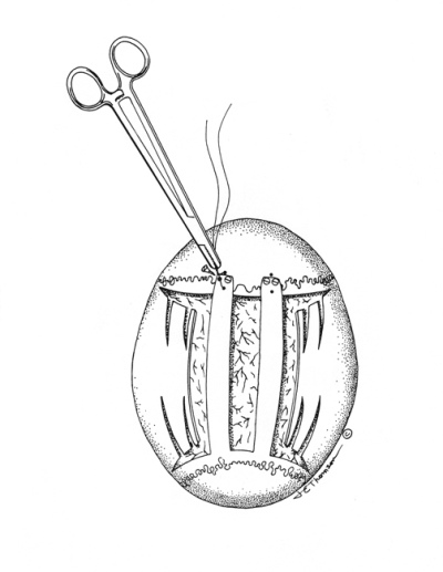 Infant skull reconstruction