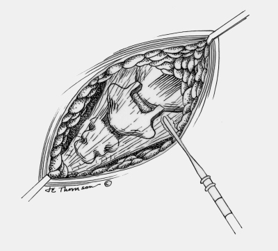 Surgery at coccyx