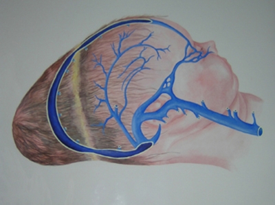 Venous sinuses Band'ls ring